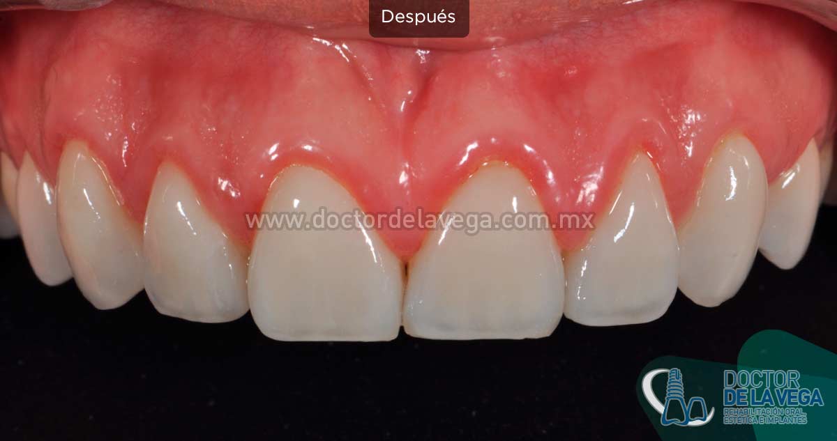 Carillas Dentales - Resultados excepcionales - Dental Piulachs